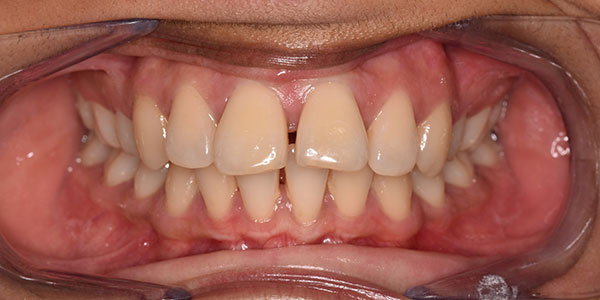 Before treatment the patient had worn teeth with some gapping